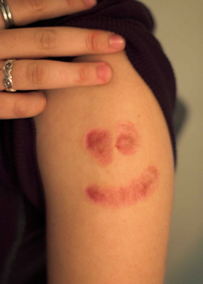 Cigarette burn damage during depression